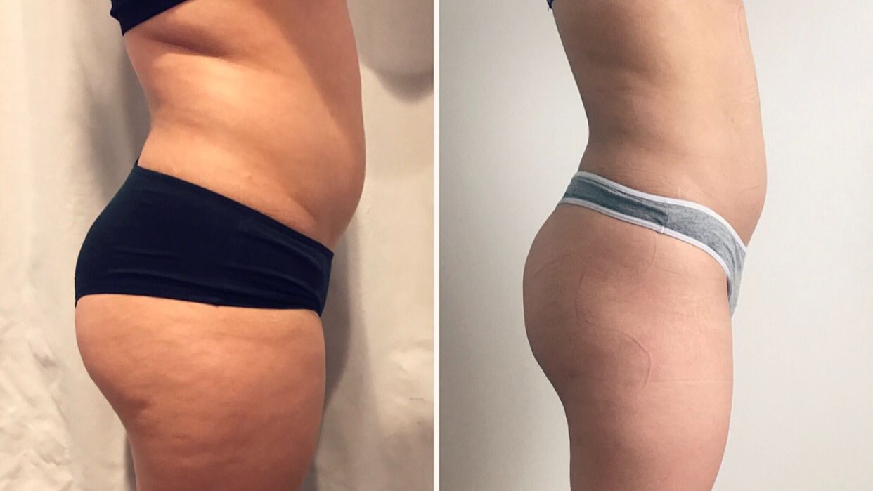 Before and After TruWave Body Treatment